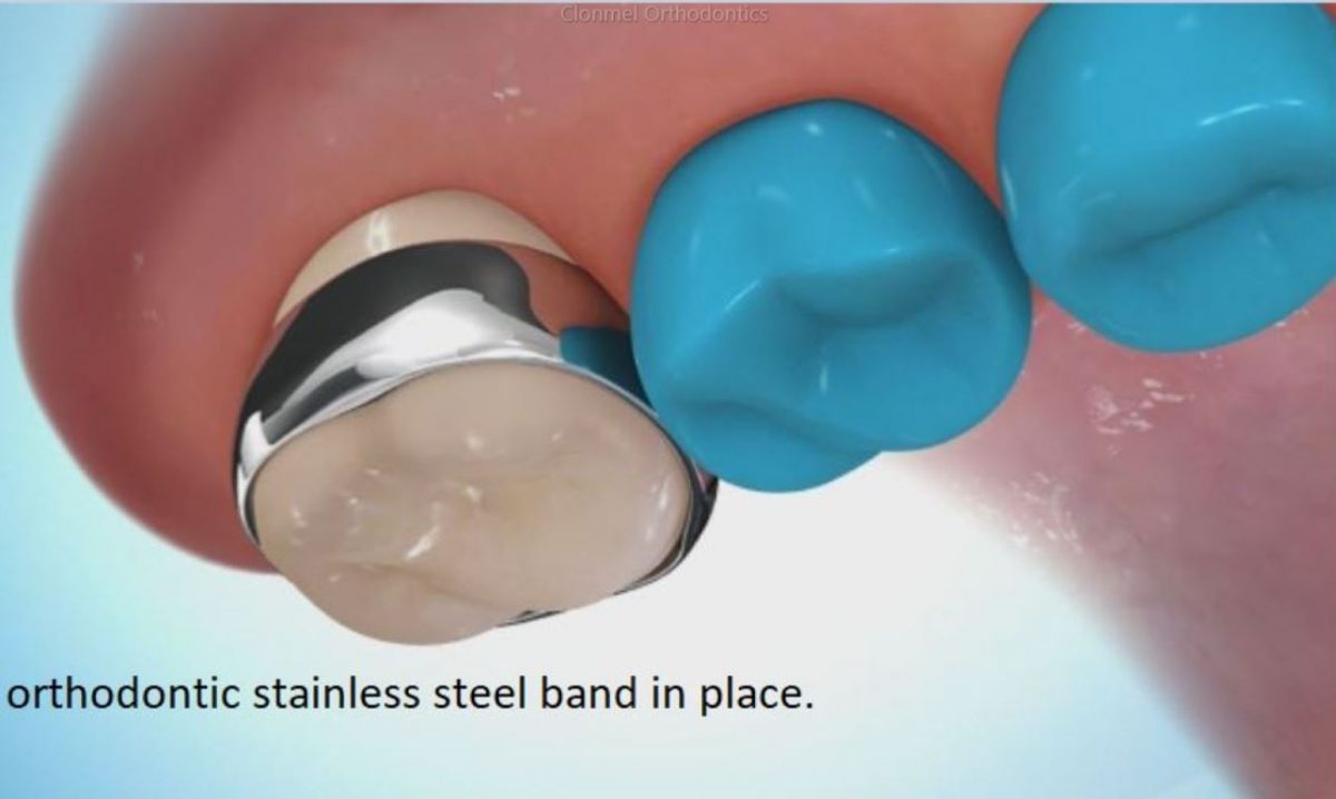 What are Orthodontic Separators / Spacers? Clonmel Orthodontics