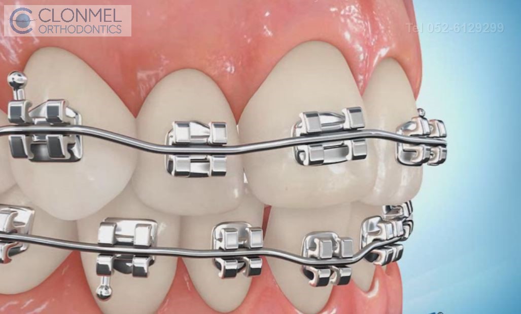 Bracket-placed-4 How are braces  put/placed on the teeth?