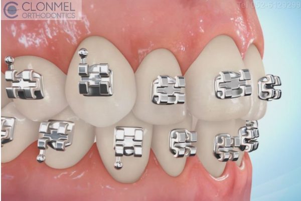 What Are Coloured Braces Clonmel Orthodontics