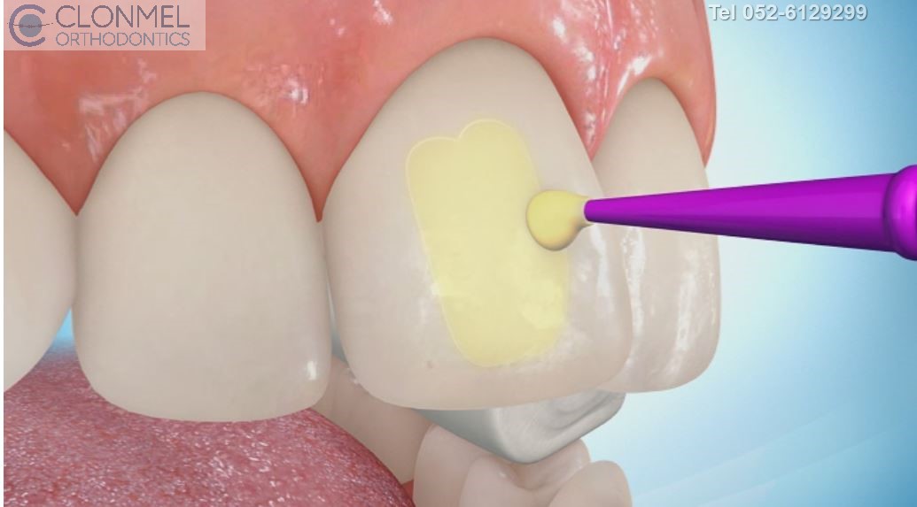 etch-1-prew How are braces  put/placed on the teeth?