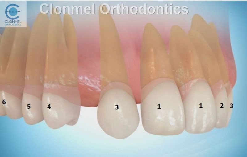 Missing Lateral Incisors Part 1. - Clonmel Orthodontics