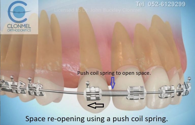 Missing Lateral Incisors Part 2. 